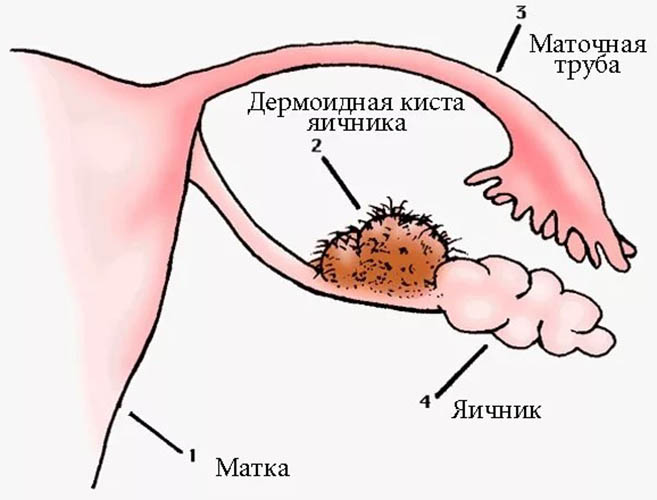 Тератома яичника. Что это такое у женщин, клинические рекомендации