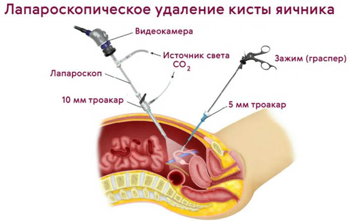 Тератома яичника. Что это такое у женщин, клинические рекомендации