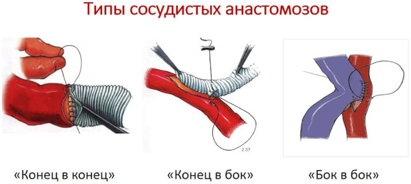 Цереброваскулярная болезнь (ЦВБ). Что это такое, симптомы, лечение