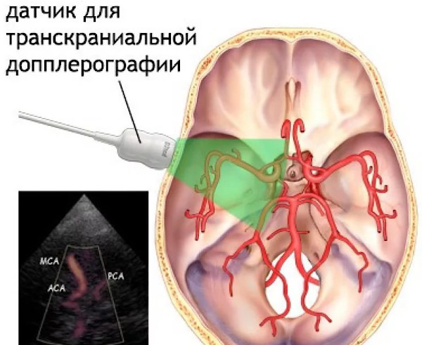 Цереброваскулярная болезнь (ЦВБ). Что это такое, симптомы, лечение