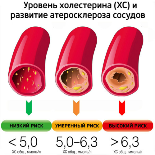 Цереброваскулярная болезнь (ЦВБ). Что это такое, симптомы, лечение