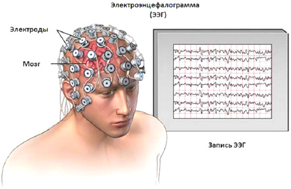 Цереброваскулярная болезнь (ЦВБ). Что это такое, симптомы, лечение