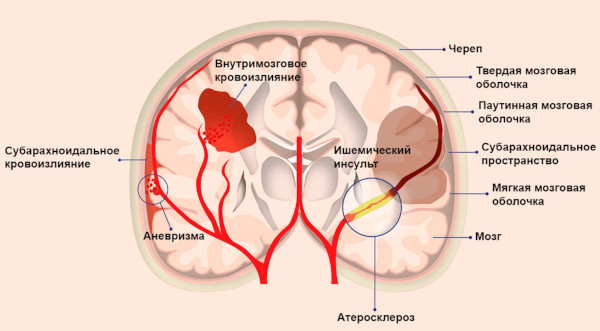 Цереброваскулярная болезнь (ЦВБ). Что это такое, симптомы, лечение