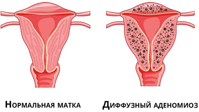 Увеличена матка. Причины, почему, кроме беременности