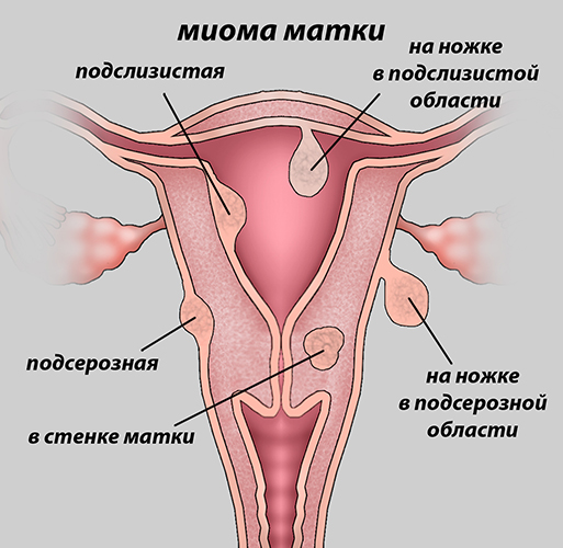 Увеличена матка. Причины, почему, кроме беременности