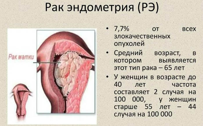 Увеличена матка. Причины, почему, кроме беременности