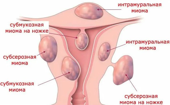 Узловая миома матки. Лечение малых, больших размеров