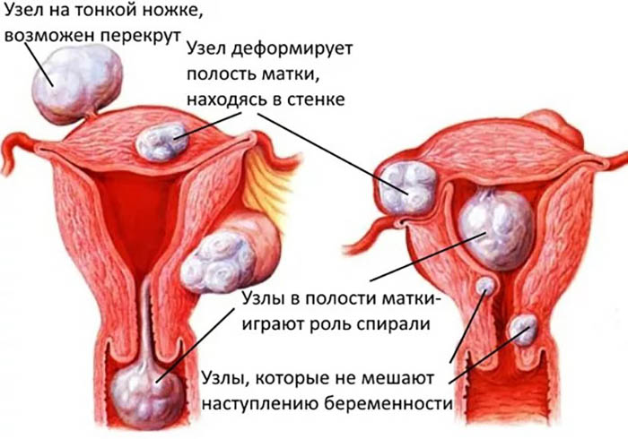 Узловая миома матки. Лечение малых, больших размеров