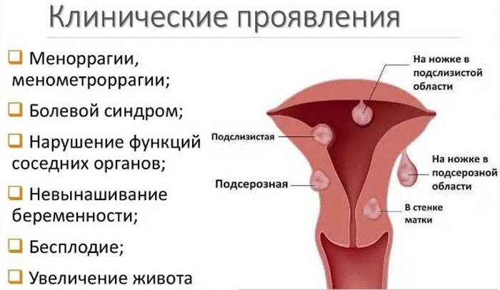 Узловая миома матки. Лечение малых, больших размеров