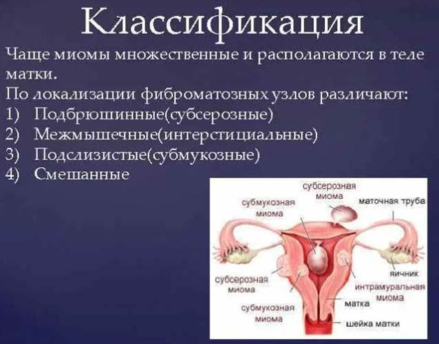 Узловая миома матки. Лечение малых, больших размеров