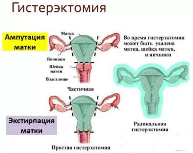 Узловая миома матки. Лечение малых, больших размеров