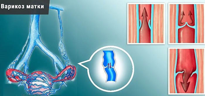 Варикозное расширение вен матки. Лечение
