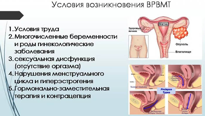 Варикозное расширение вен матки. Лечение