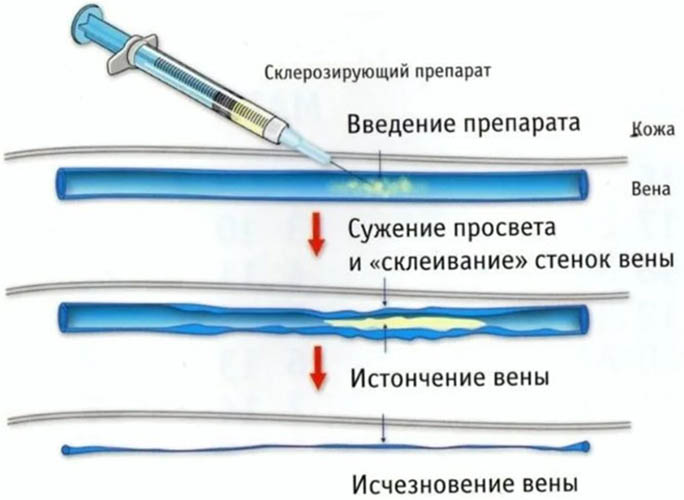 Варикозное расширение вен матки. Лечение