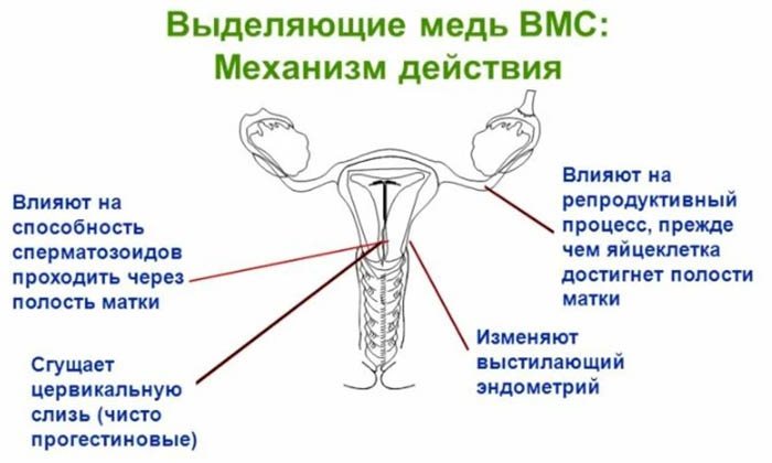 Внутриматочная контрацепция. Виды, показания, механизм действия