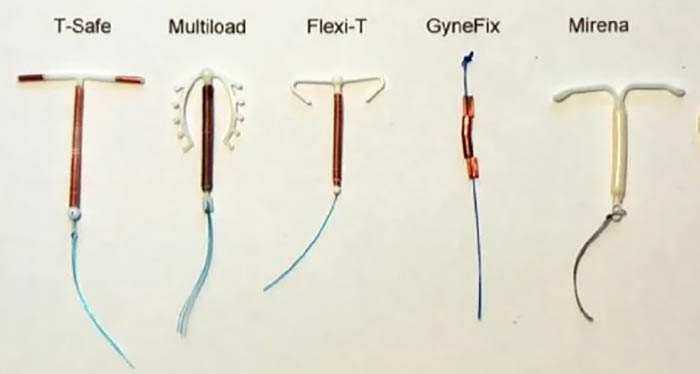Внутриматочная контрацепция. Виды, показания, механизм действия