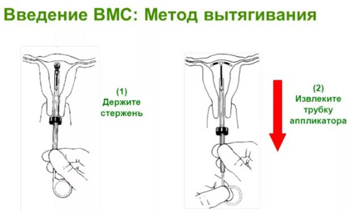 Внутриматочная контрацепция. Виды, показания, механизм действия