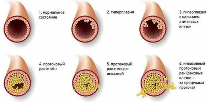 Внутрипротоковая папиллома молочной железы. Лечение