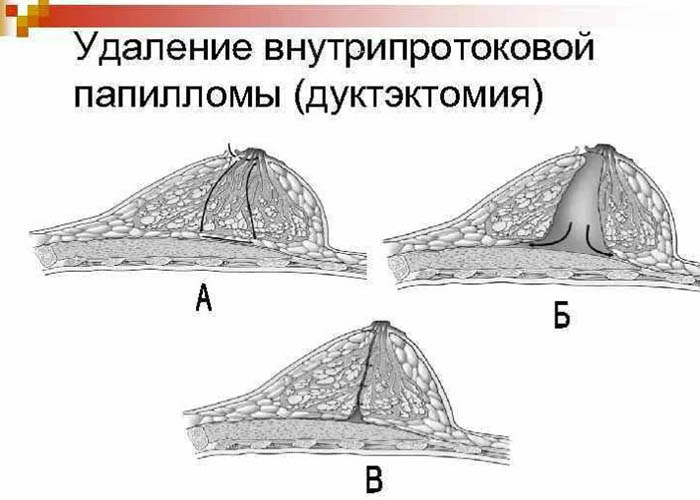 Внутрипротоковая папиллома молочной железы. Лечение