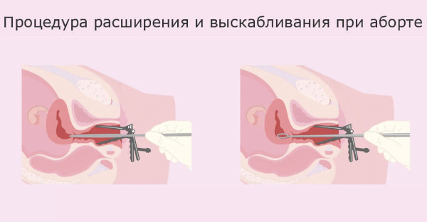 Выделения после аборта медикаментозного, вакуумного. Сколько длятся