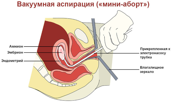 Выделения после аборта медикаментозного, вакуумного. Сколько длятся