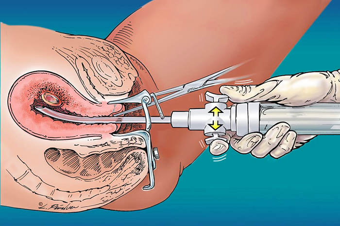 Выскабливание полости матки. Что это такое в гинекологии