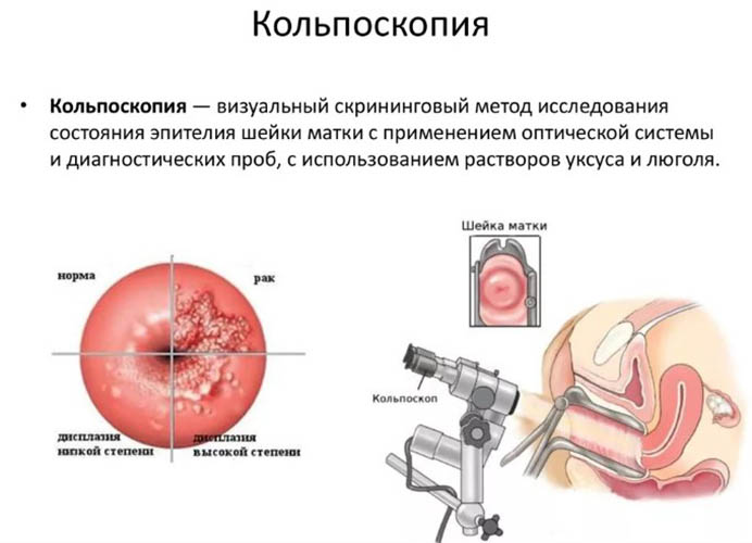 Выскабливание полости матки. Что это такое в гинекологии