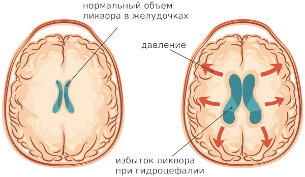 Заболевания нервной системы. Список самых распространенных