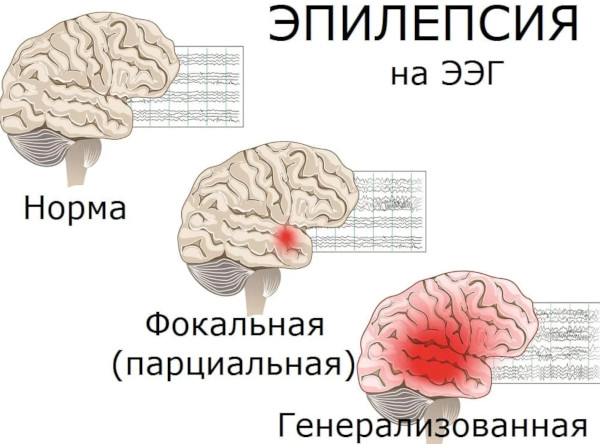 Заболевания нервной системы. Список самых распространенных