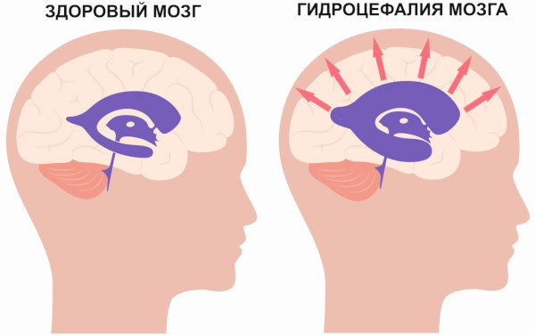 Заболевания нервной системы. Список самых распространенных