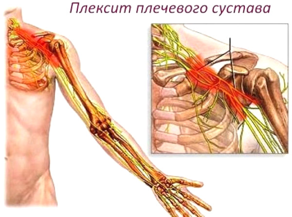 Заболевания периферической нервной системы. Список, классификация