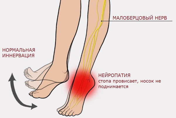 Заболевания периферической нервной системы. Список, классификация