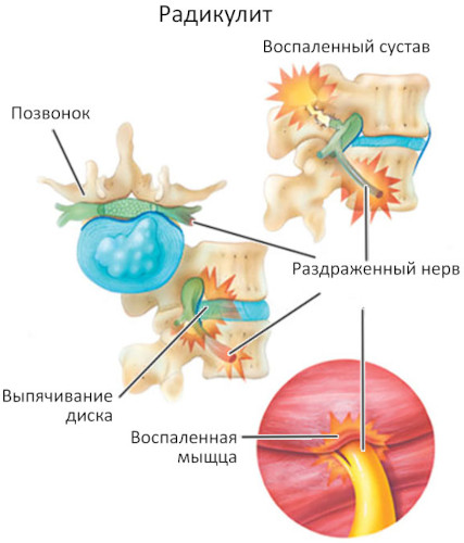 Заболевания периферической нервной системы. Список, классификация