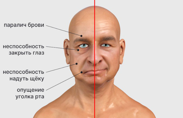 Заболевания периферической нервной системы. Список, классификация