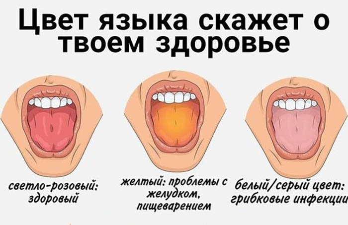 Желтый язык у ребенка, налет. Почему, что означает