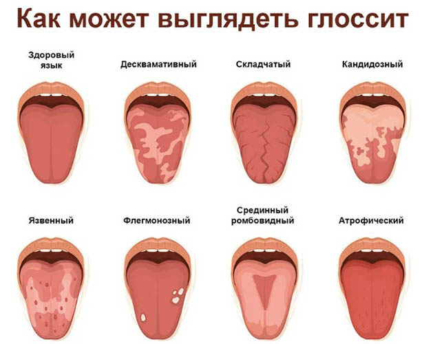 Желтый язык у ребенка, налет. Почему, что означает