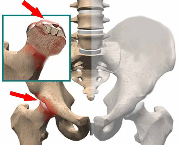 Асептический некроз головки тазобедренного сустава. Лечение