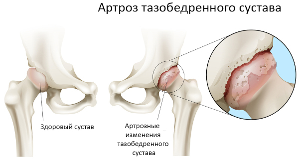 Асептический некроз головки тазобедренного сустава. Лечение