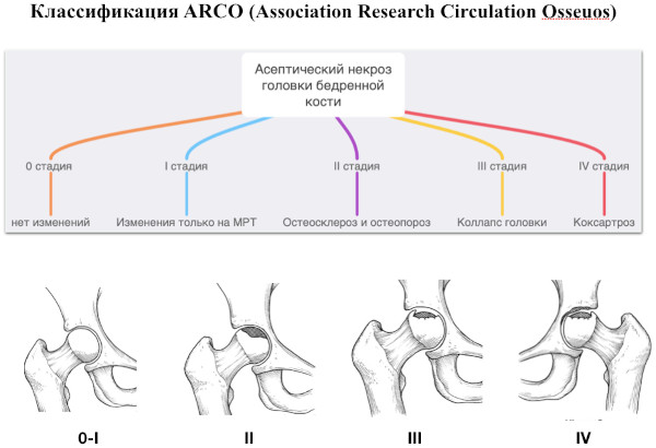 Асептический некроз головки тазобедренного сустава. Лечение