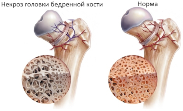 Асептический некроз головки тазобедренного сустава. Лечение