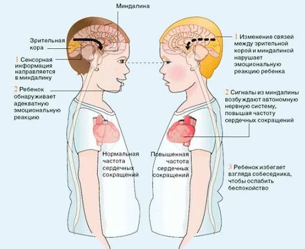 Атипичный аутизм у детей без умственной отсталости. Симптомы, лечение