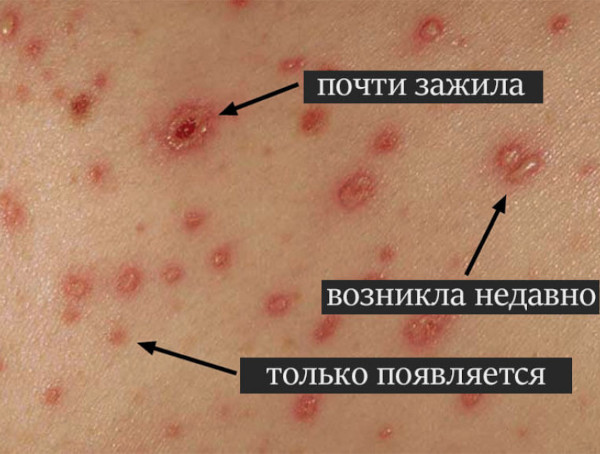 Ацикловир при ветрянке у детей. Дозировка, отзывы