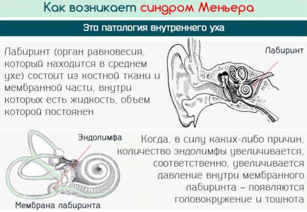 Бетагистин. Аналоги и заменители дешевле