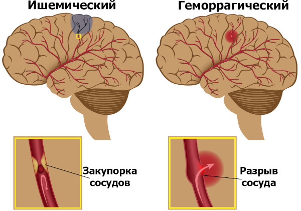 Болезни головного мозга. Список, симптомы, названия