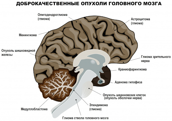 Болезни головного мозга. Список, симптомы, названия