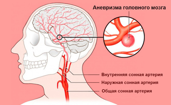 Болезни головного мозга. Список, симптомы, названия