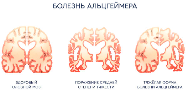 Болезни головного мозга. Список, симптомы, названия