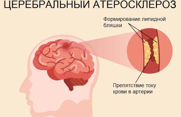 Болезни головного мозга. Список, симптомы, названия