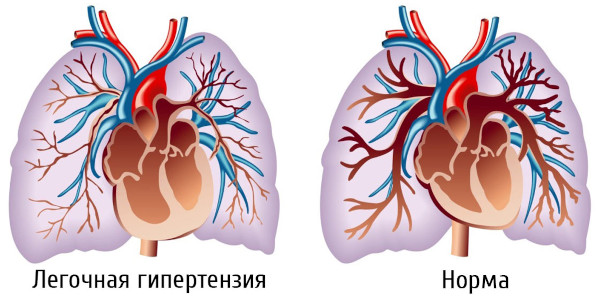 Болезни системы кровообращения