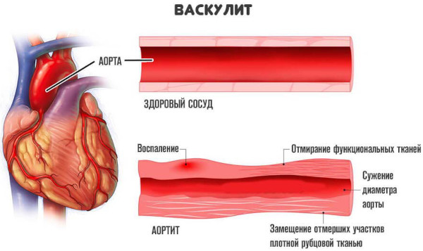 Болезни системы кровообращения